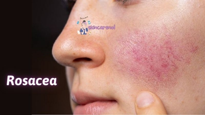 Rosacea