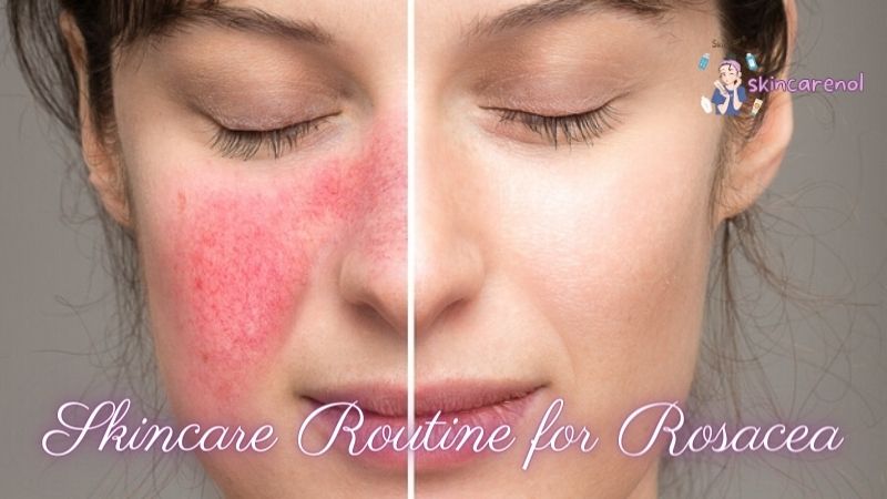 Skincare Routine for Rosacea