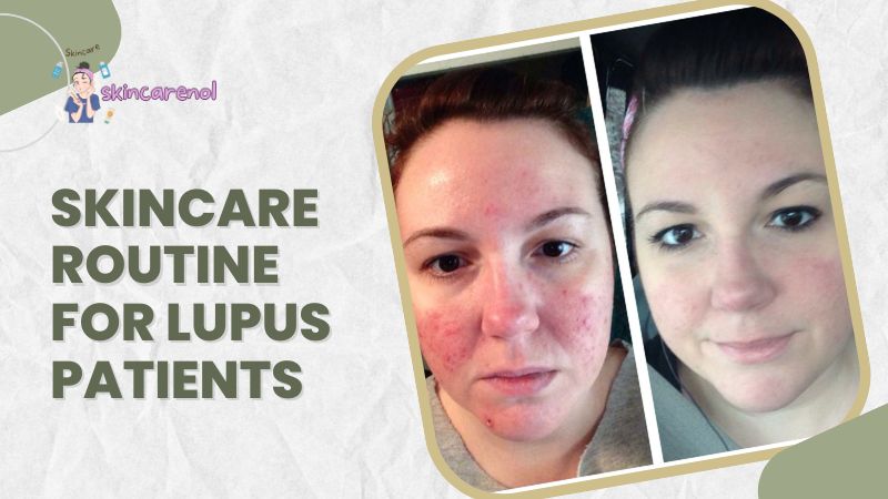 Skincare Routine for Lupus Patients